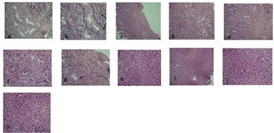 Case report: Dupilumab treatment improved type 2 disorders in a patient with IPEX syndrome diagnosis